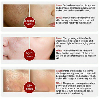 Pore Shrinkage Liquid Remove Blackhead Whitehead Acne Deep Cleansing Whitening.