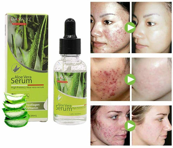 Natural Acne Skin Repair Soothing Liquid High Potency Aloe Vera Facial Serum