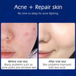 2 Pack Acne Removal Nicotinamide Cream Aloe Vera Oil Control Shrink Pores