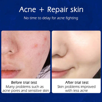 2 Pack Acne Removal Nicotinamide Cream Aloe Vera Oil Control Shrink Pores