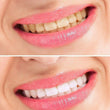 2 Pcs Venicare Professional Single Speeds Up Dental Teeth Whitening LED Light