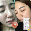 Rtopr Pimple Scar Acne Mark Spots Removal Treatment Gel Ointment Blemish Cream