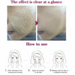 Rtopr Pimple Scar Acne Mark Spots Removal Treatment Gel Ointment Blemish Cream