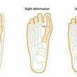 2 Pcs Gel Toe Separators Stretchers Alignment Bunion Splint Toe Straightener