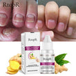 RtopR Ginger Antibacterial Fungal Nail Treatment Nail Repair Essential Oil Serum