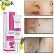 RtopR Acne Spots Anti Scar Stretch Marks Remover Skin Repair Face Cream 20g