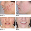 Acne Treatment Face Cream Acne Removal Gel Remove Pimple Skin Repair Cream