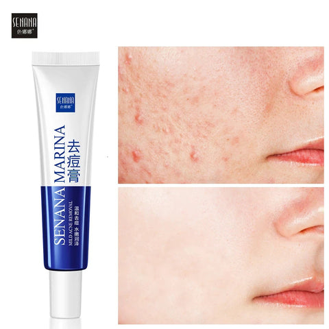 2 Pack Acne Removal Nicotinamide Cream Aloe Vera Oil Control Shrink Pores