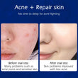 Acne Removal Nicotinamide Cream Aloe Vera Oil Control Shrink Pores Blackhead