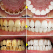 Teeth Whitening Pen Tooth Bleaching Whitener Oral Gel System